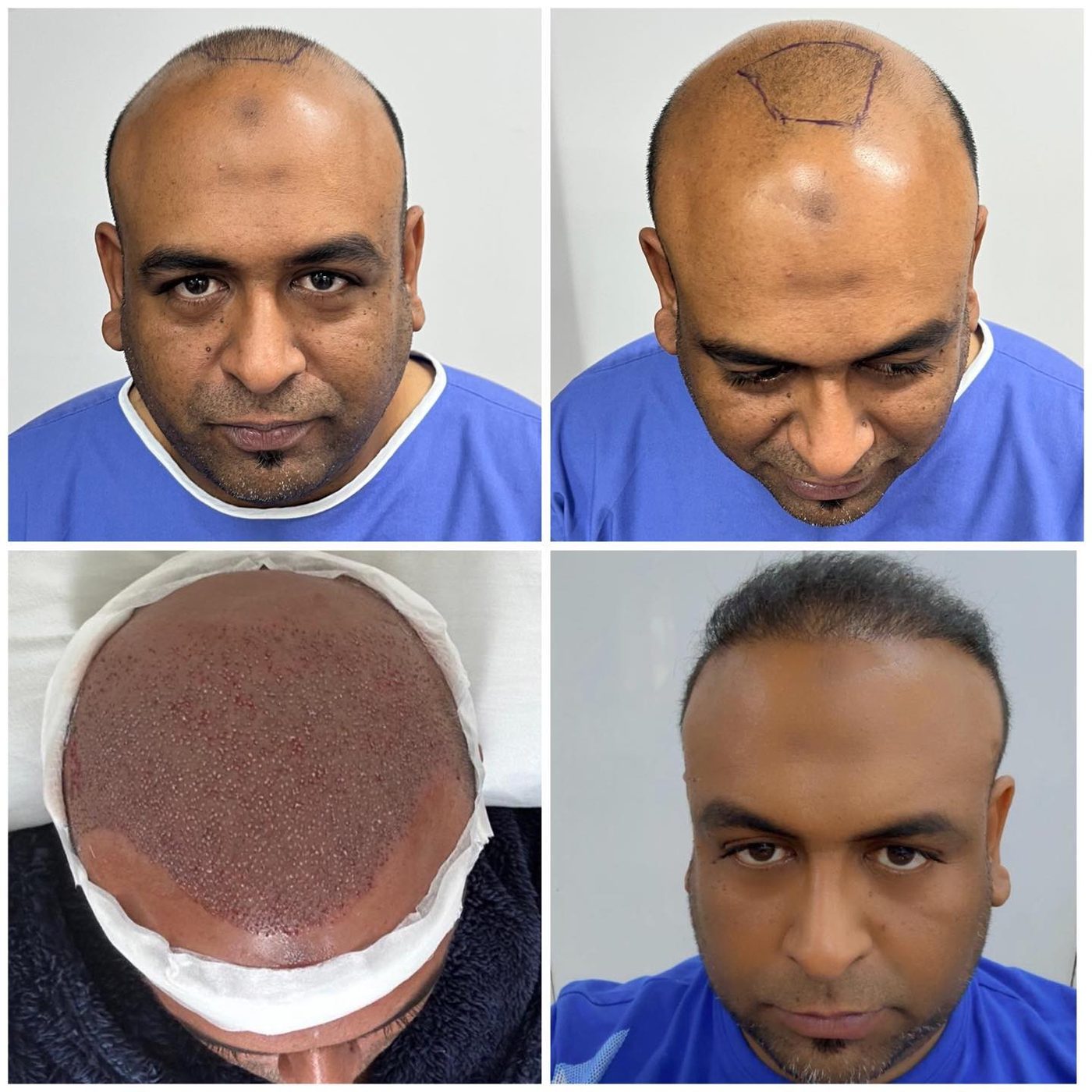 Hair restoration patient moment from the clinic