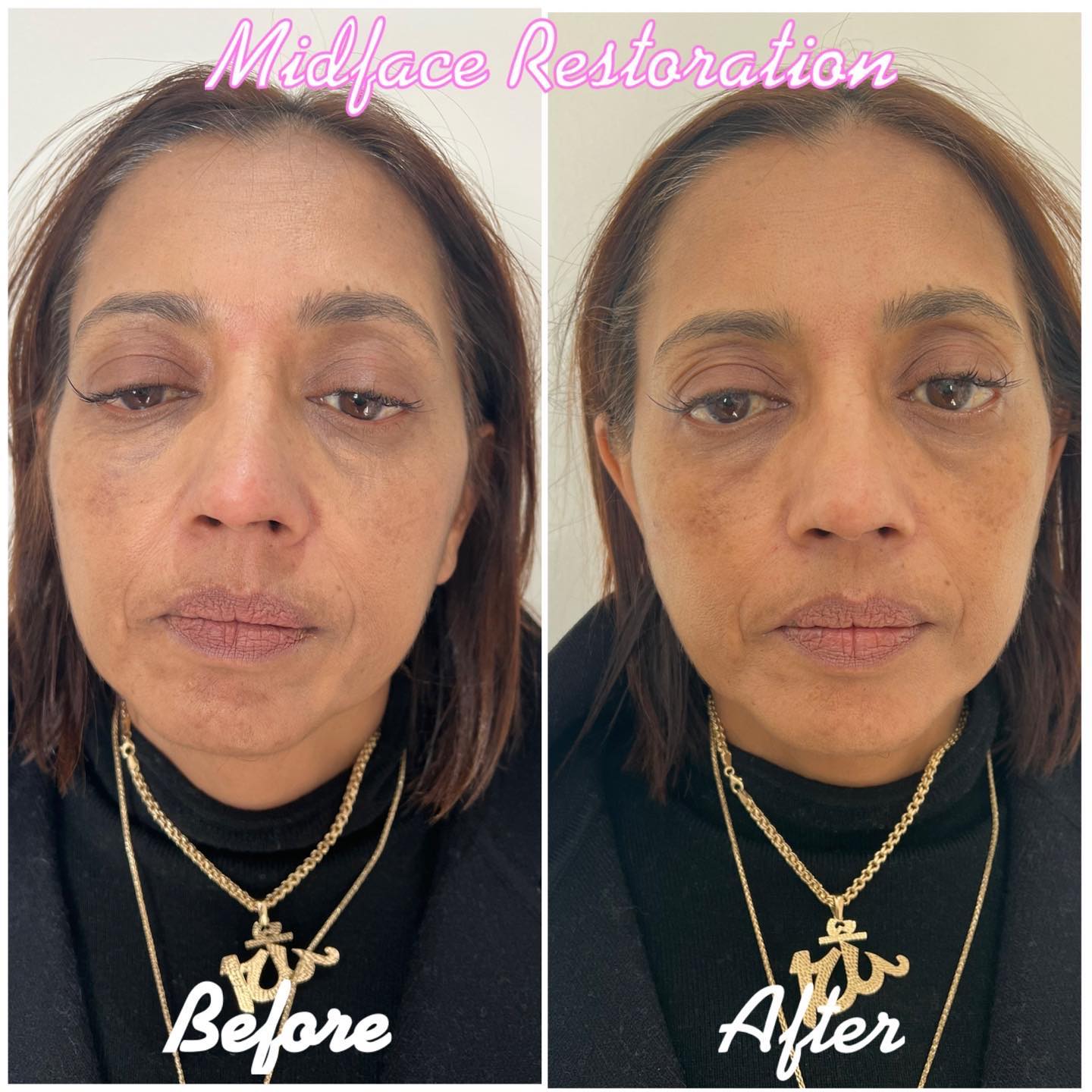 Before and after midface restoration treatment example